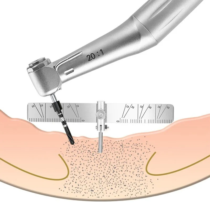 Dental Implant Surgical Guide Bendable Dental Implant Locating Guide Angle Rulers